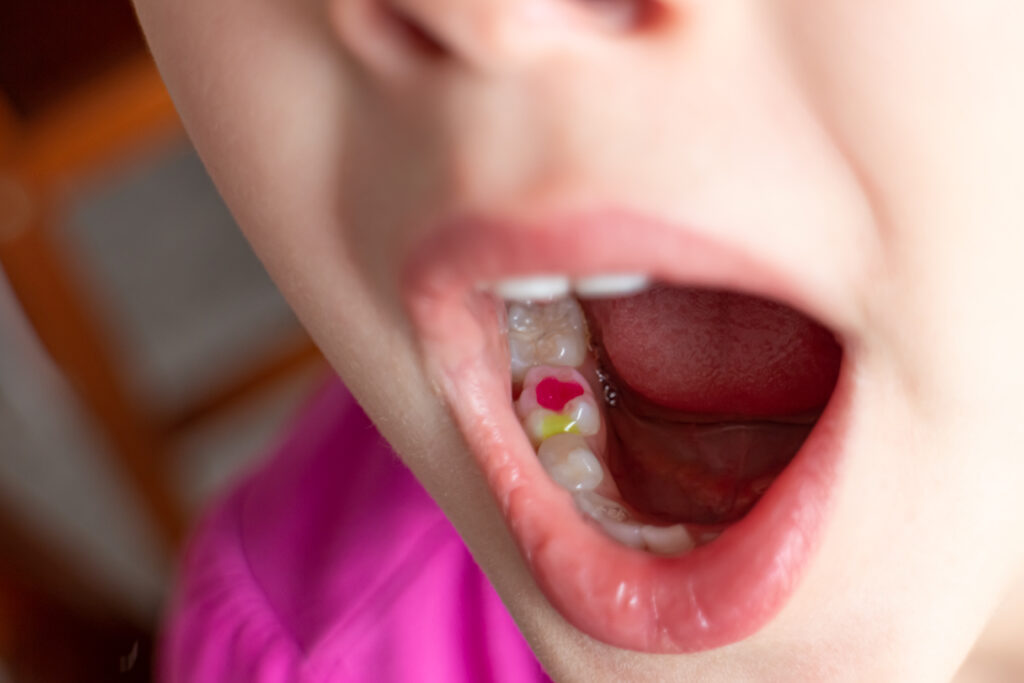 Tooth-Colored Fillings for Kids in Snoqualmie