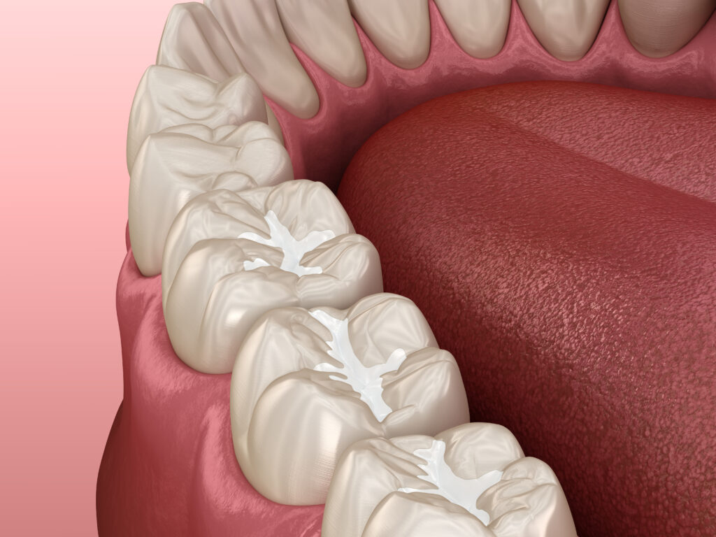 Dental Sealants Snoqualmie